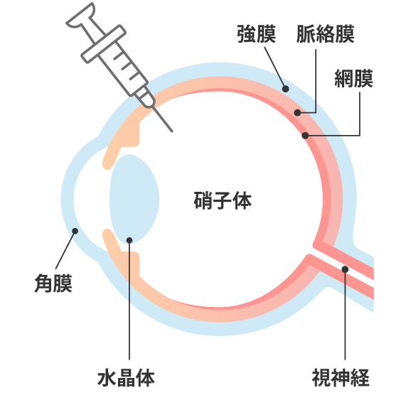 硝子体注射